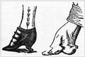 Tight shoes as shown in Jefferis and 
Nichols household guide, p.291.