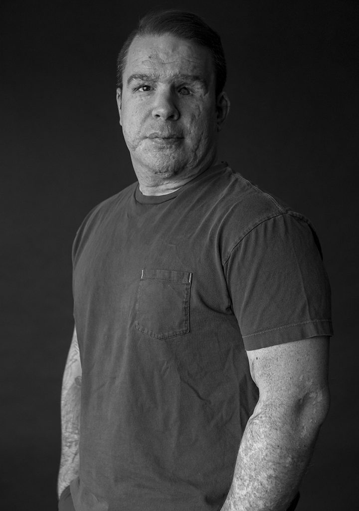 Portrait en noir et blanc d’un homme en tee-shirt qui n’a qu’un œil et dont le visage est marqué de cicatrices